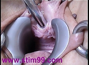Peehole resolution shagging urethral sound intercalate dilation
